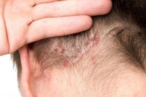 Comment calmer une inflammation du cuir chevelu